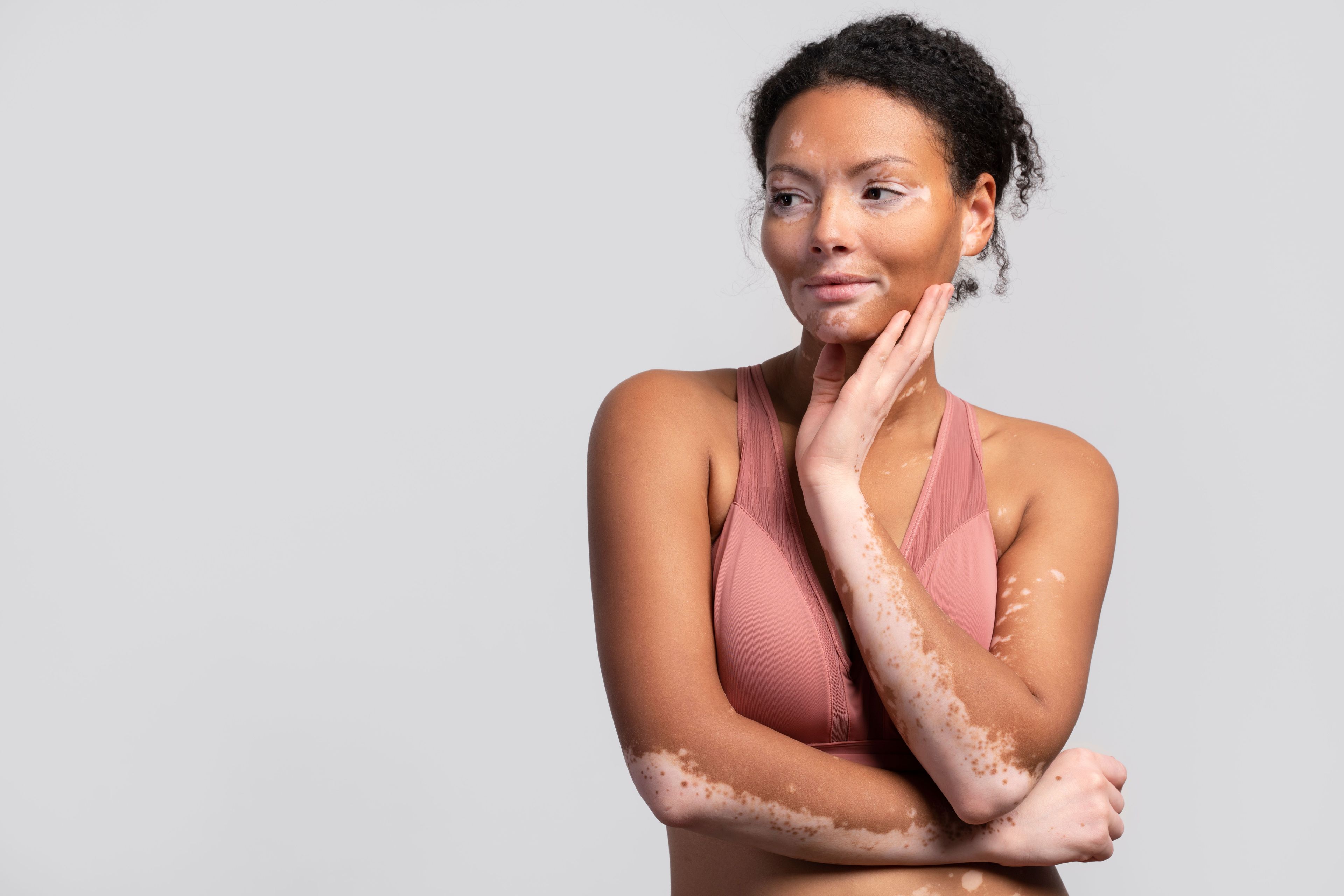 Imagem do editorial: Vitiligo 